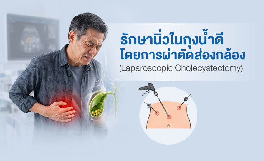 ผ่าตัดส่องกล้องนิ่วในถุงน้ำดี