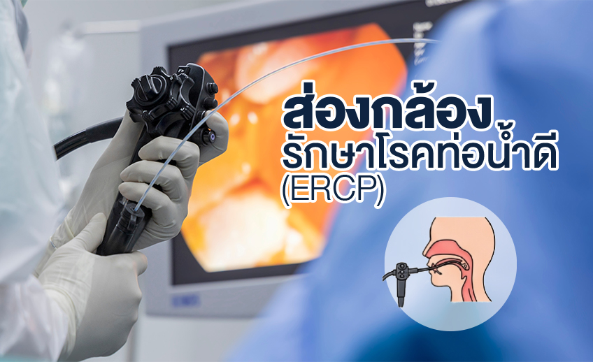 ส่องกล้องรักษาโรคท่อน้ำดี