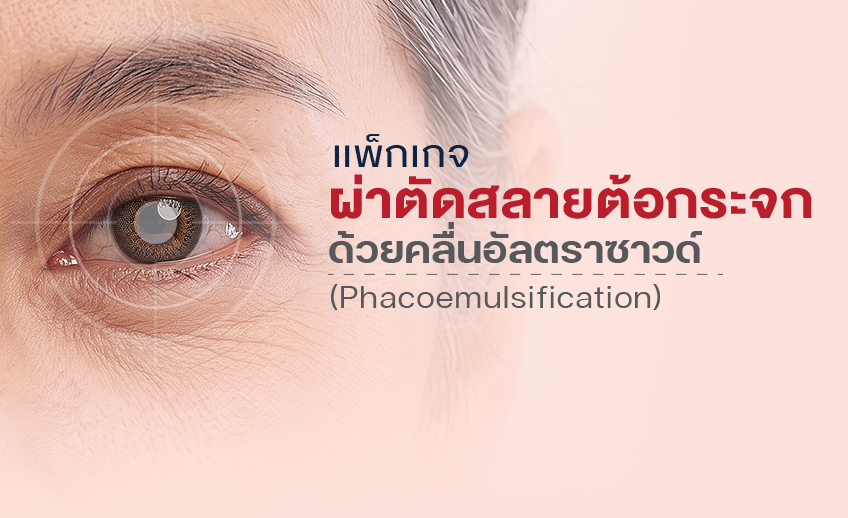 แพ็กเกจผ่าตัดสลายต้อกระจกด้วยคลื่นอัลตราซาวด์
