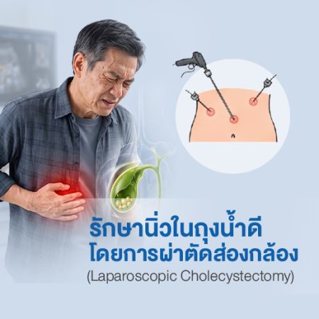 ผ่าตัดส่องกล้องนิ่วในถุงน้ำดี