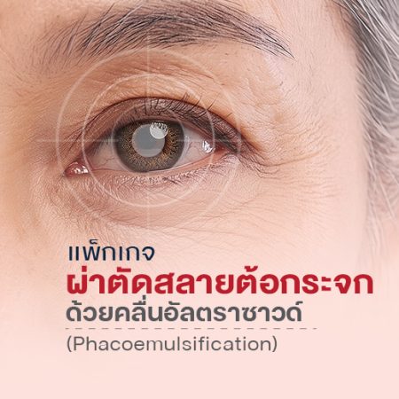 ผ่าตัดสลายต้อกระจก ด้วยคลื่นอัลตราซาวด์