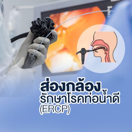 ส่องกล้อง รักษาโรคท่อน้ำดี (ERCP)